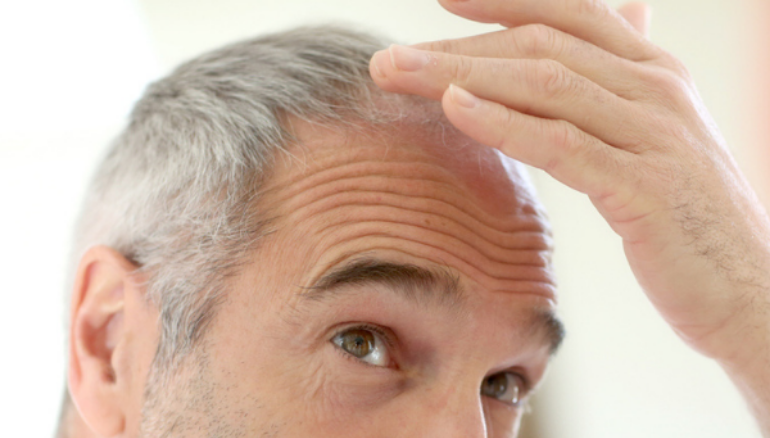 Male hair loss causes and treatment | Healthy Male